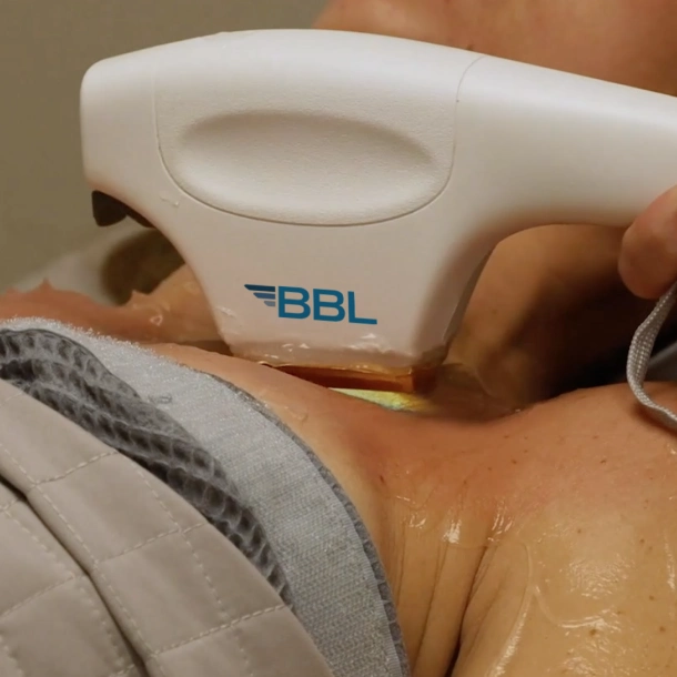 Forever Young BBL Body Laser Treatment in Albany OR | Pure Beauty Aesthetics