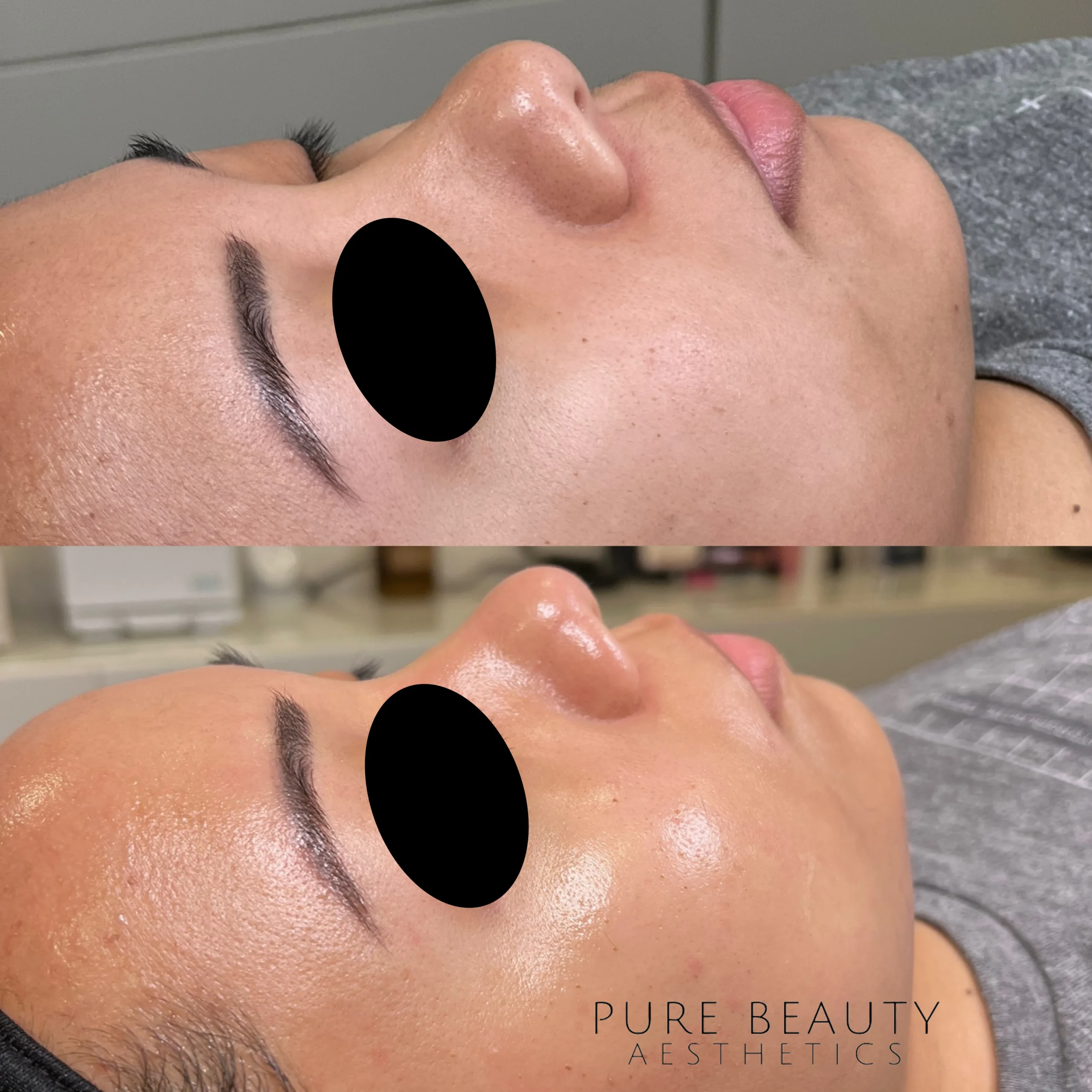 HydraFacial BA A In Albany OR Scaled | Pure Beauty Aesthetics