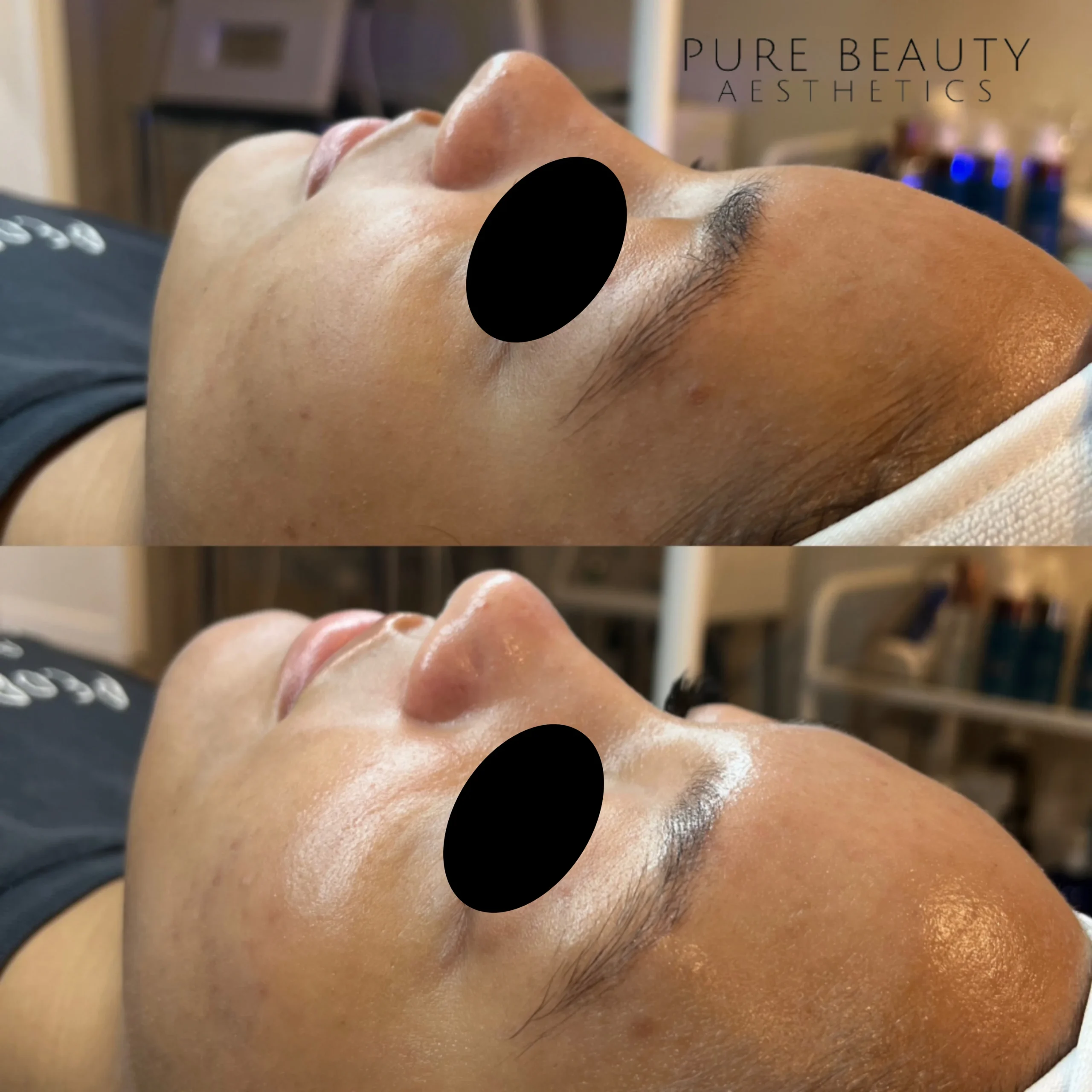 HydraFacial BA B In Albany OR | Pure Beauty Aesthetics