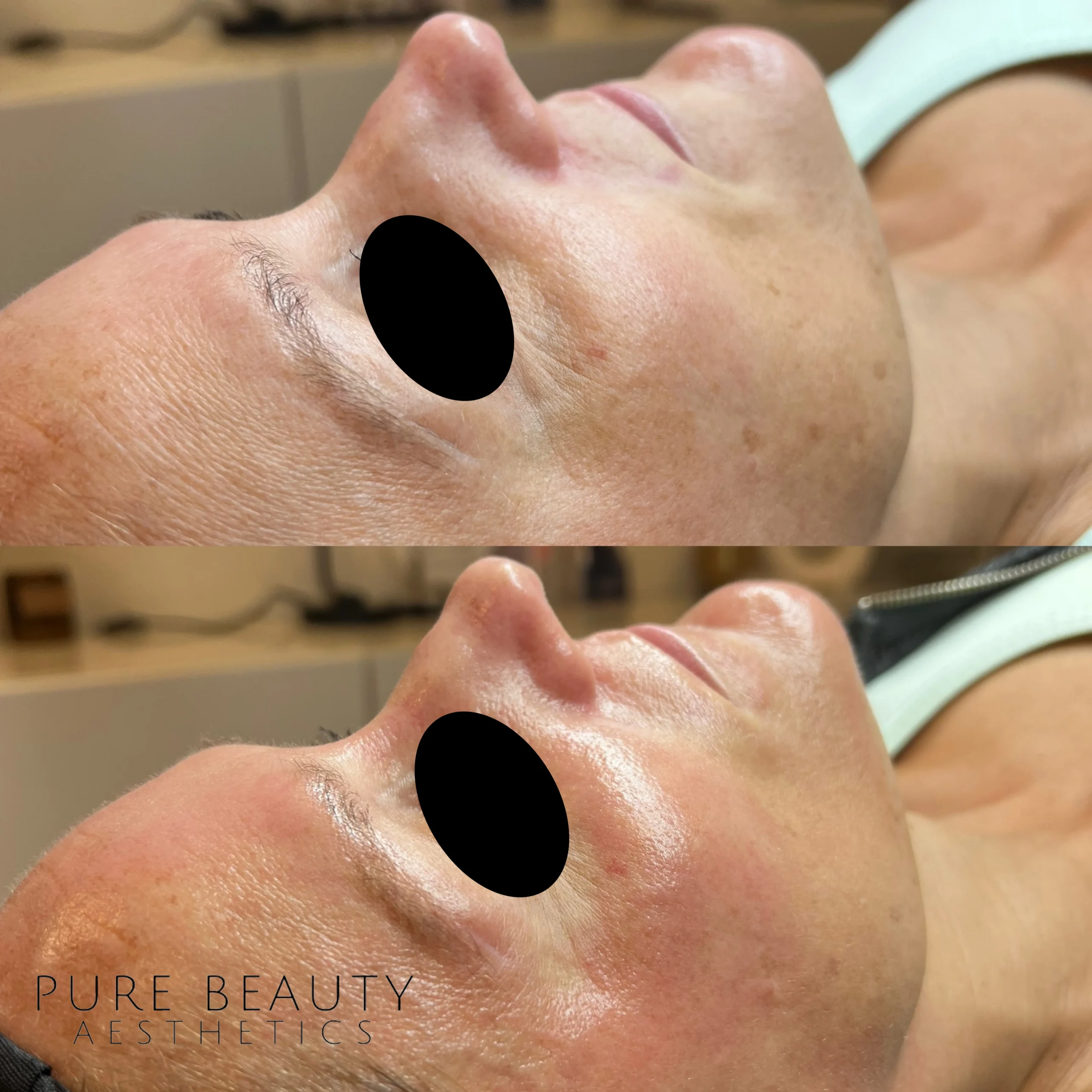 HydraFacial BA C In Albany OR | Pure Beauty Aesthetics