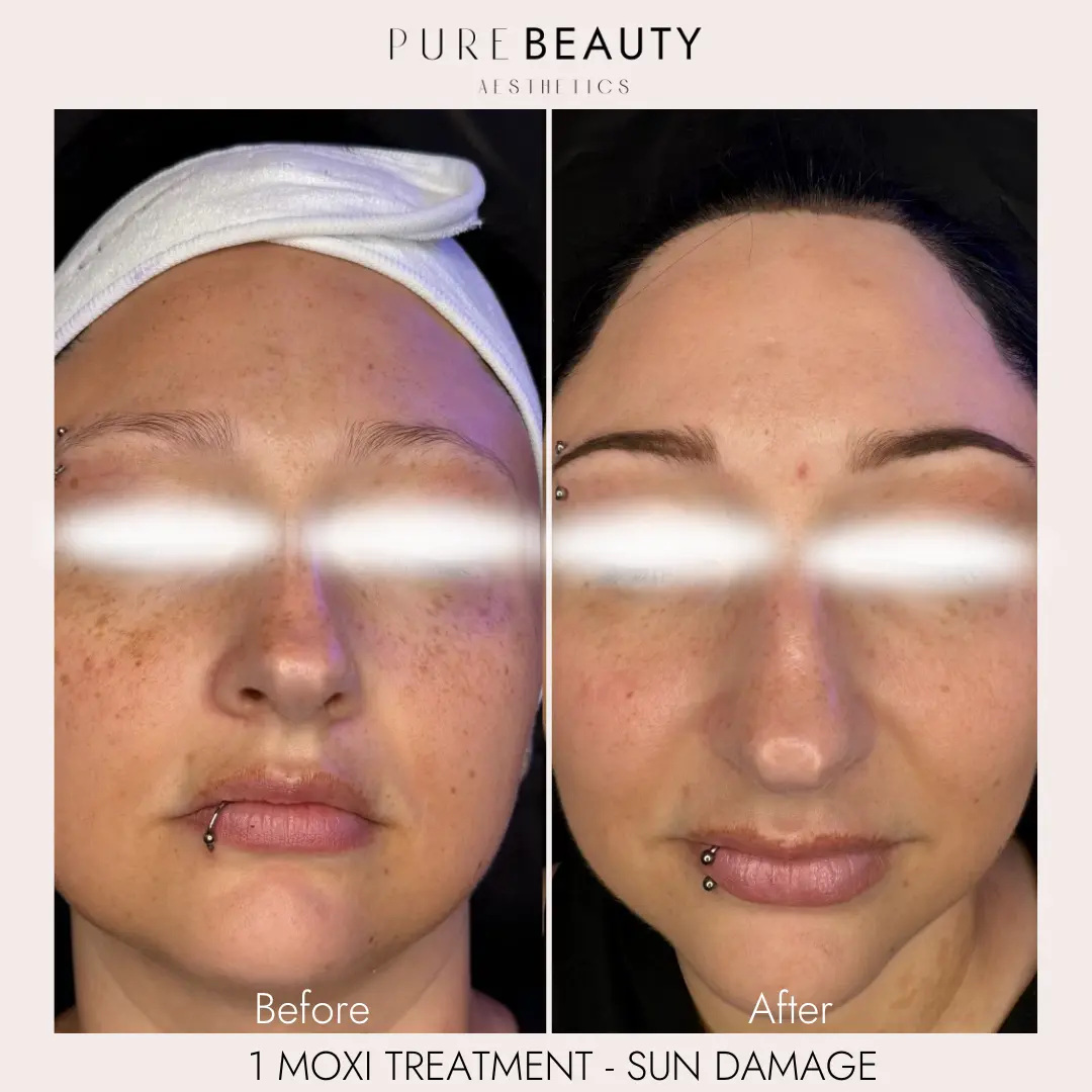 Pure Beauty Aesthetics Before & After 1