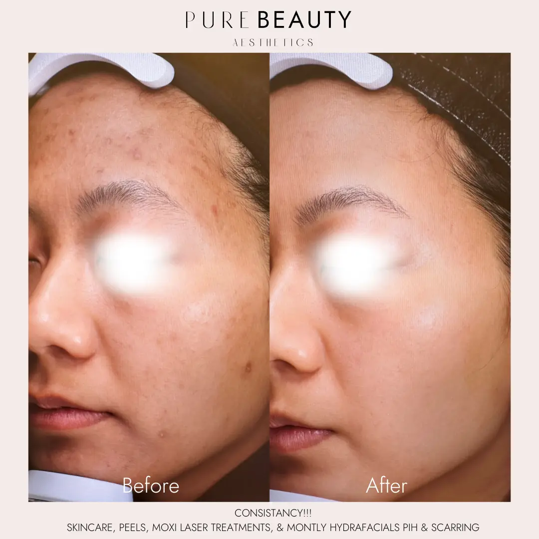 Pure Beauty Aesthetics Before & After 11
