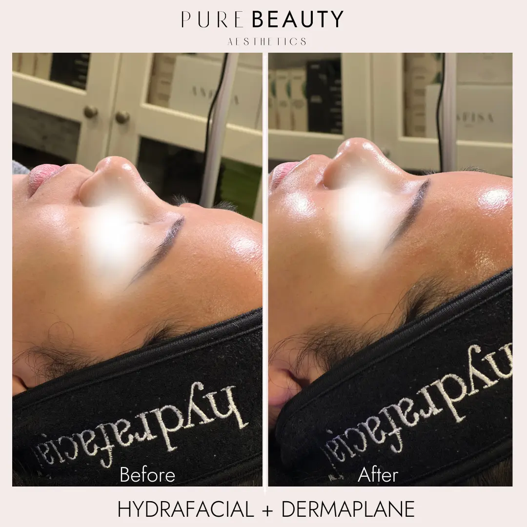 Pure Beauty Aesthetics Before & After 19