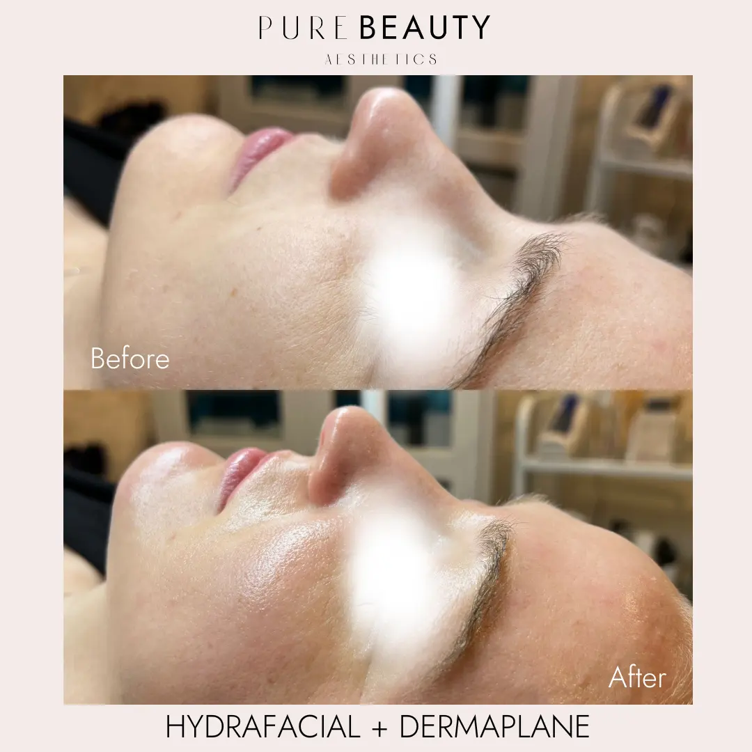 Pure Beauty Aesthetics Before & After 20