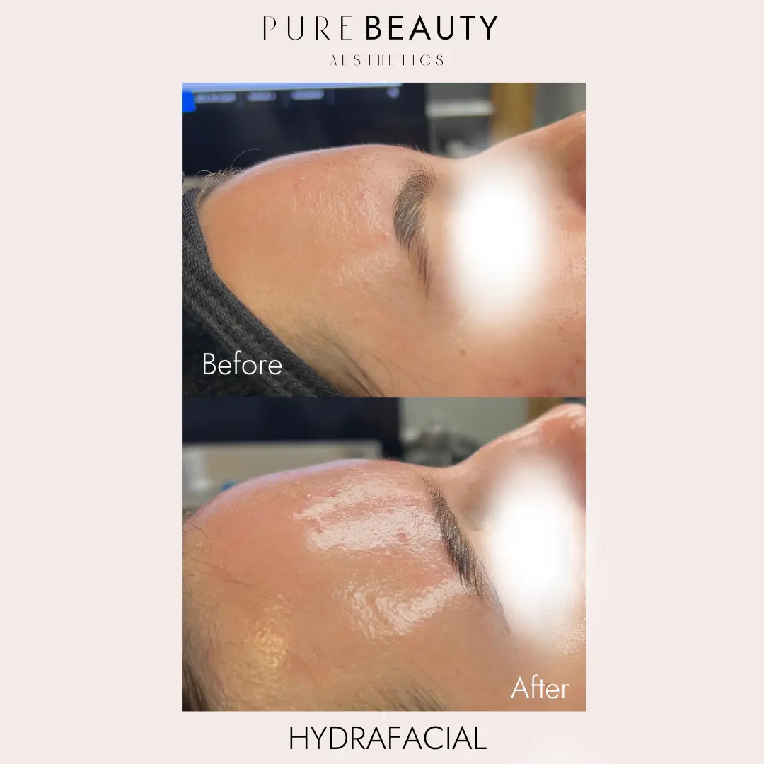 Pure Beauty Aesthetics Before & After 21