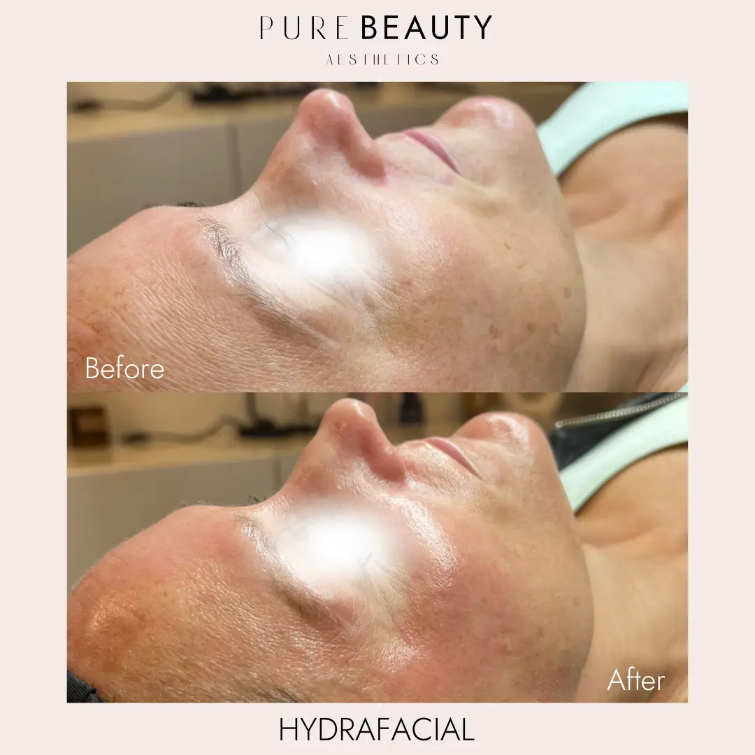 Pure Beauty Aesthetics Before & After 22