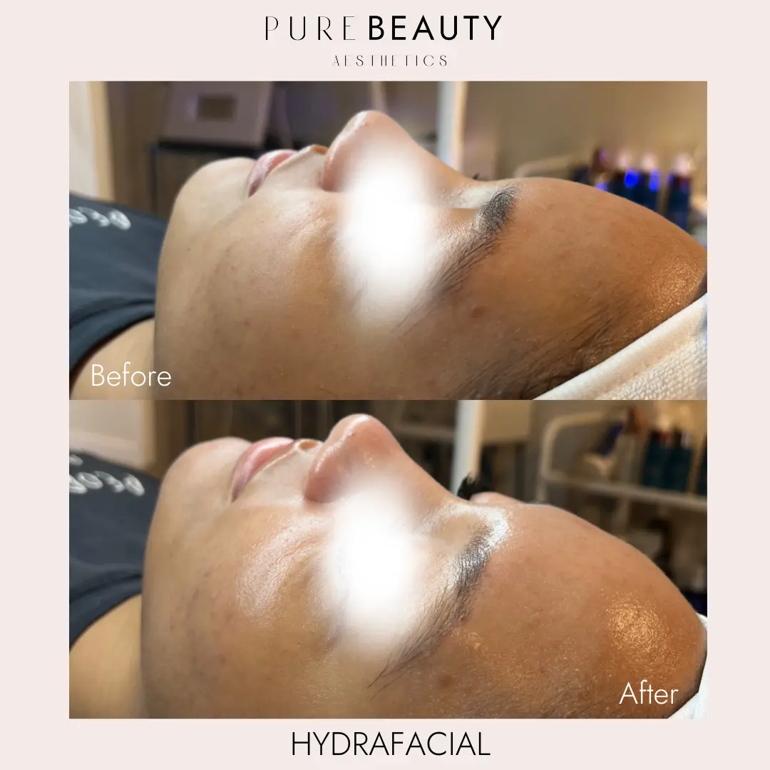 Pure Beauty Aesthetics Before & After 23