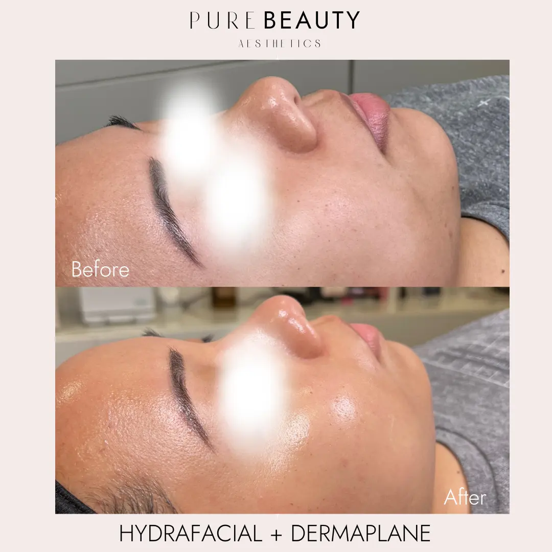 Pure Beauty Aesthetics Before & After 24