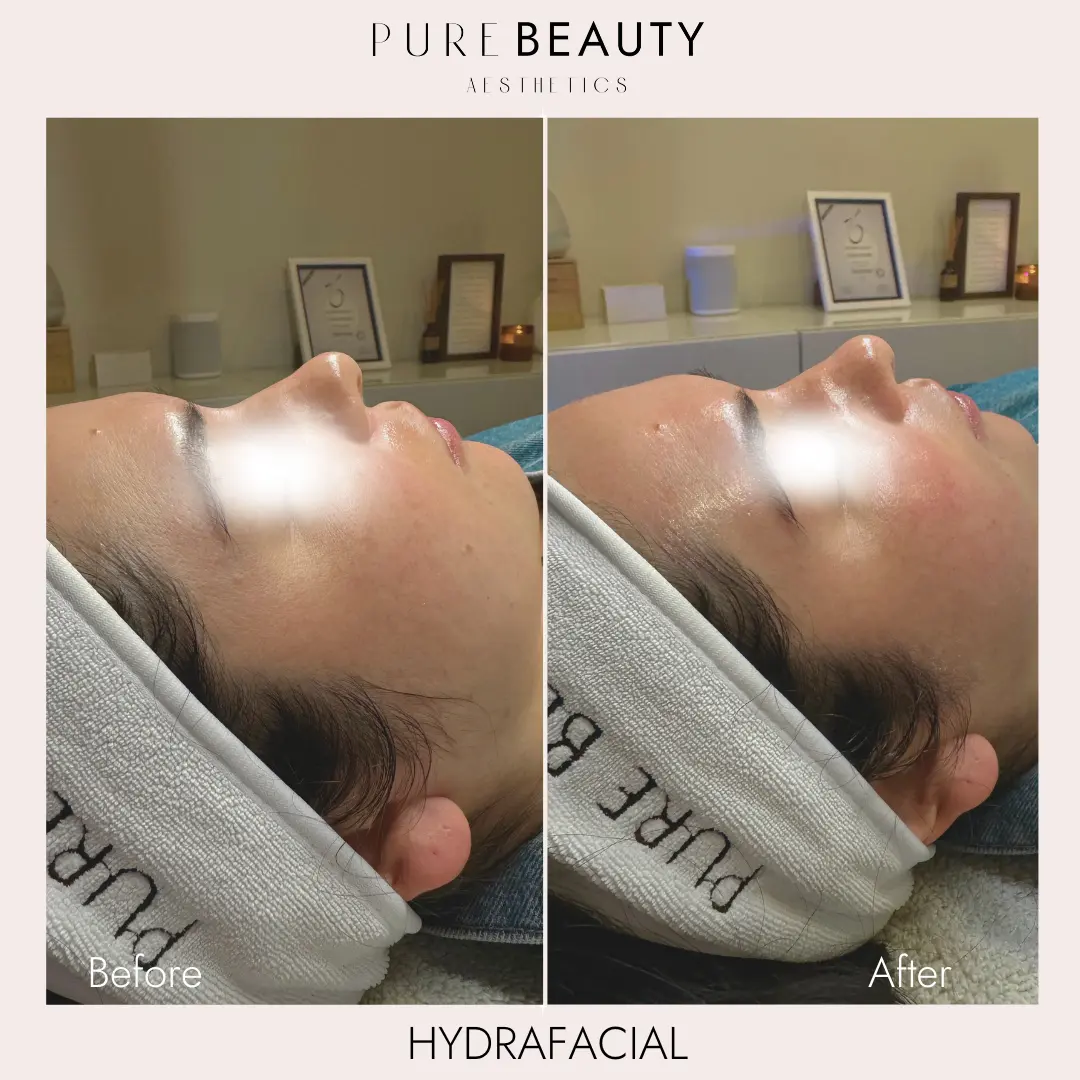 Pure Beauty Aesthetics Before & After 25