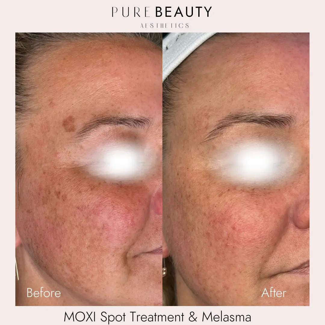 Pure Beauty Aesthetics Before & After 27