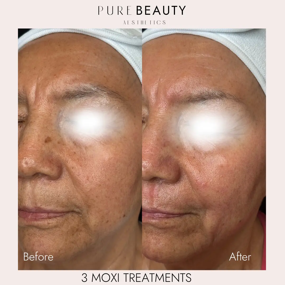 Pure Beauty Aesthetics Before & After 28