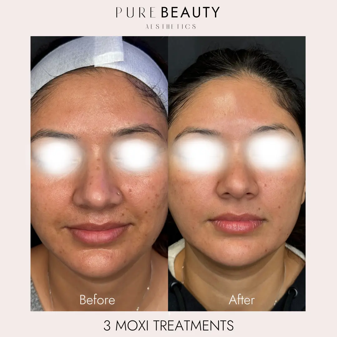 Pure Beauty Aesthetics Before & After 8