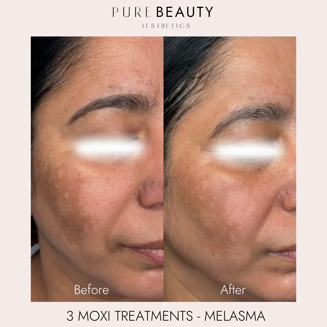 Pure Beauty Aesthetics Before & After 9