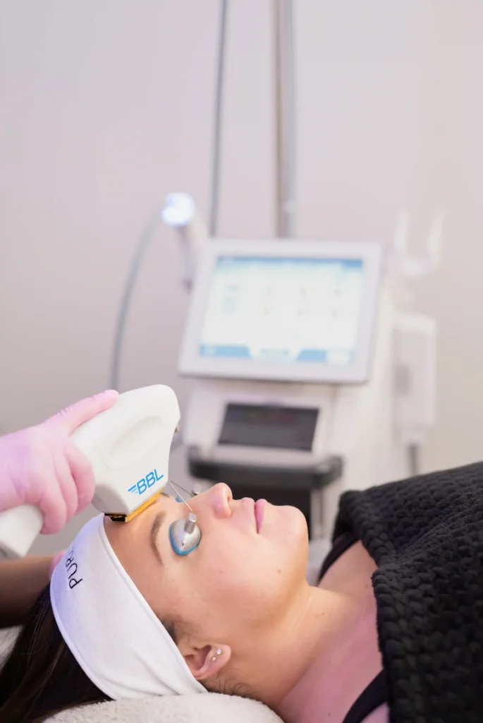 Women Receiving Forever Clear BBL Hero Laser Treatment in Albany, OR