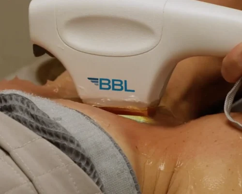 Forever Young BBL Body Laser Treatment in Albany OR | Pure Beauty Aesthetics