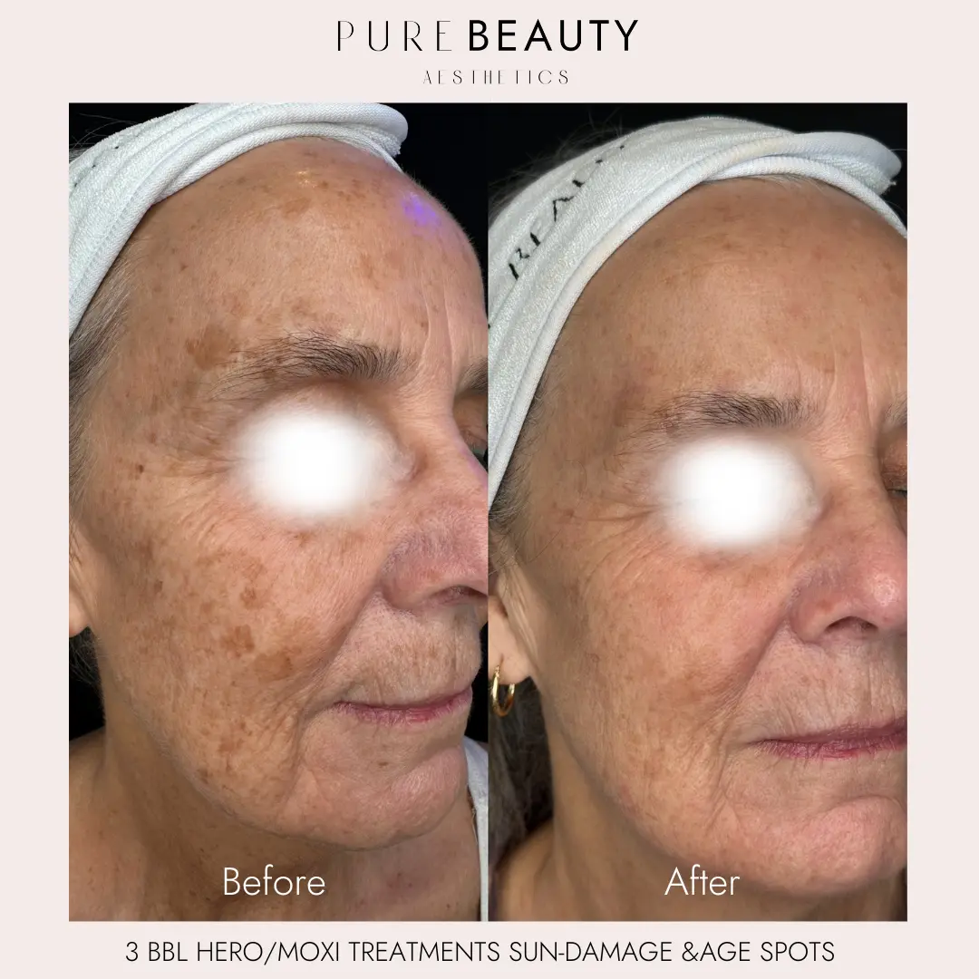 Pure Beauty Aesthetics Before & After 10