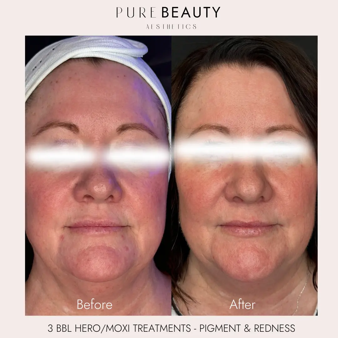 Pure Beauty Aesthetics Before & After 12