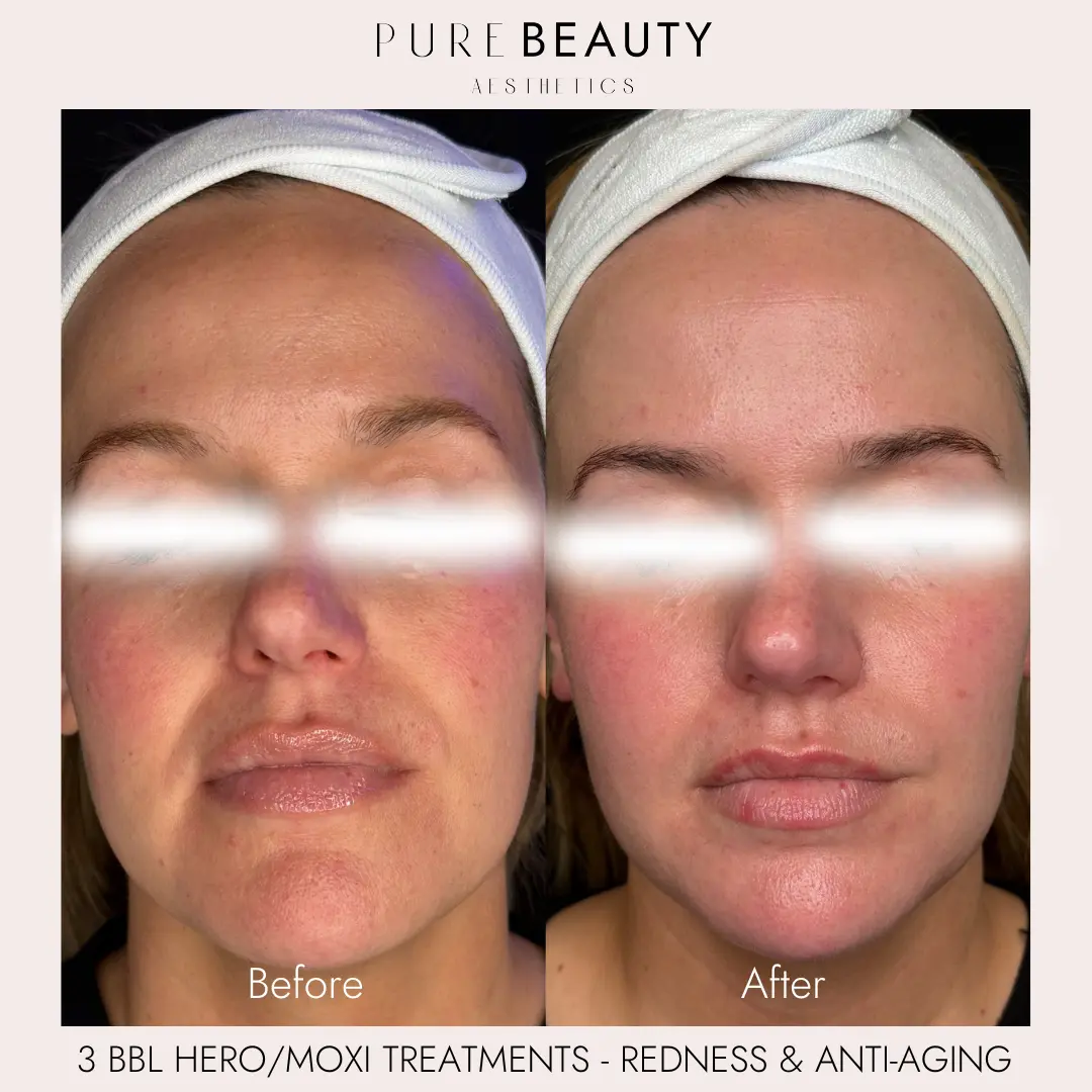 Pure Beauty Aesthetics Before & After 13