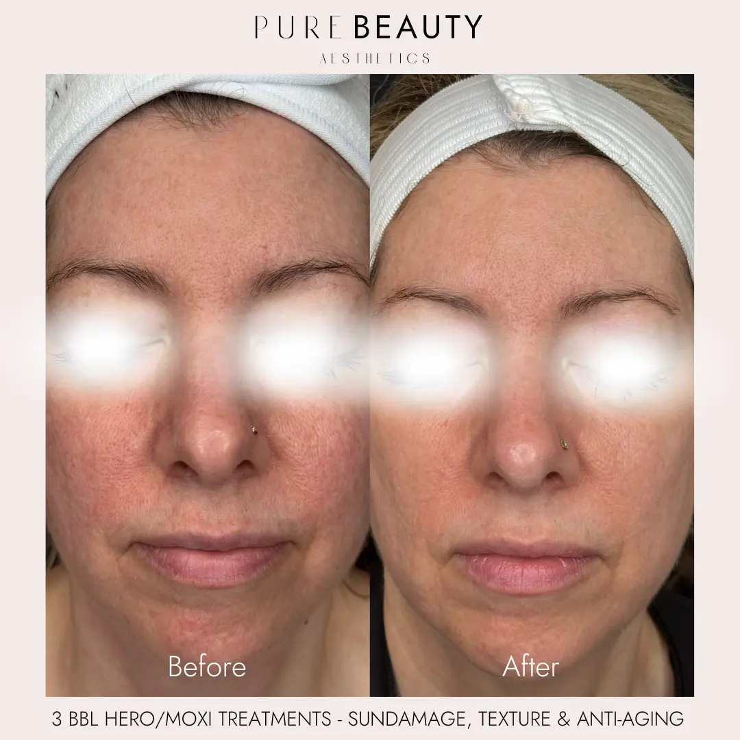 Pure Beauty Aesthetics Before & After 14