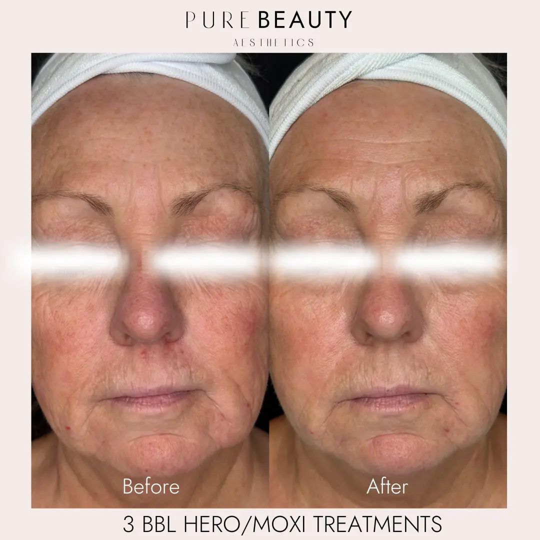 Pure Beauty Aesthetics Before & After 15