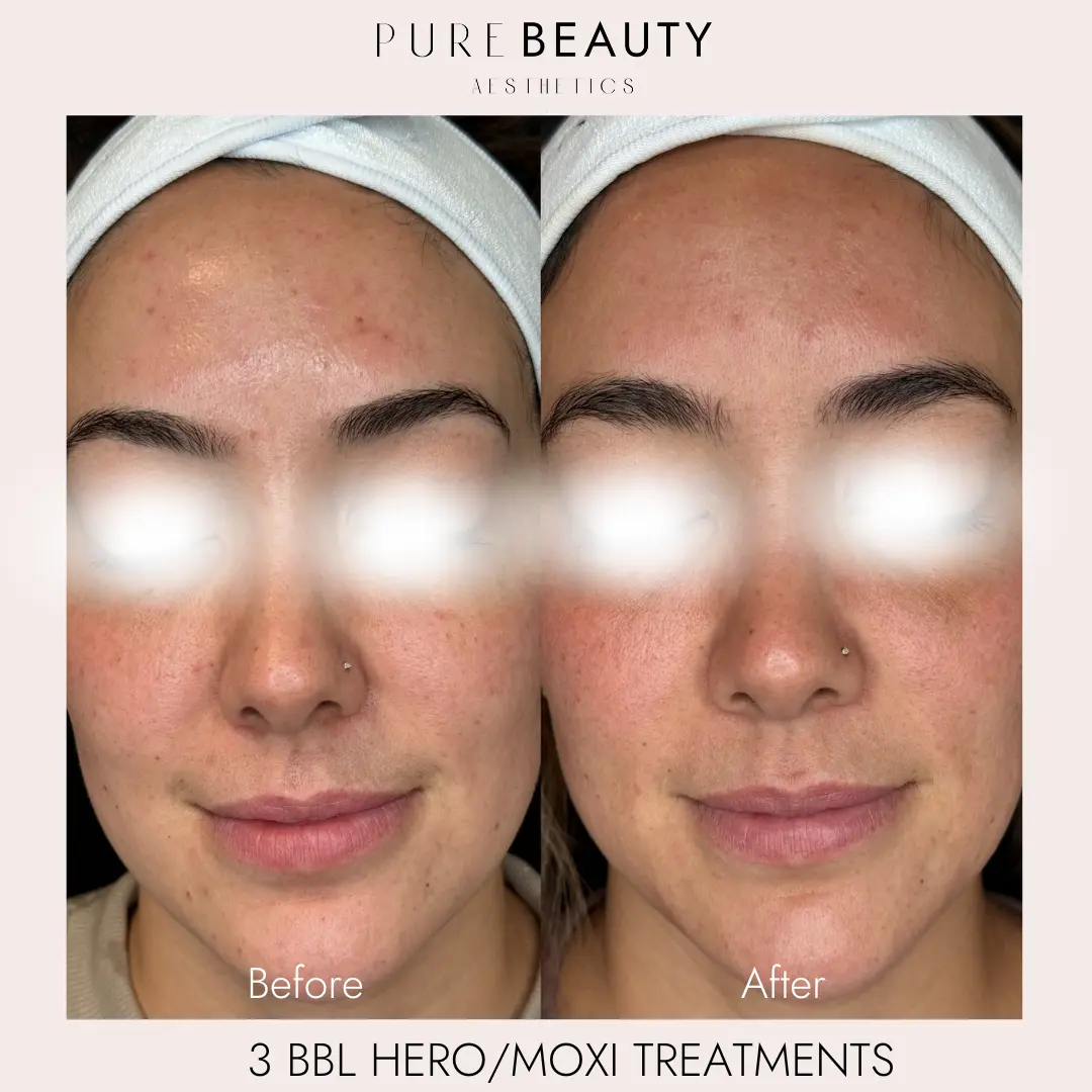 Pure Beauty Aesthetics Before & After 16