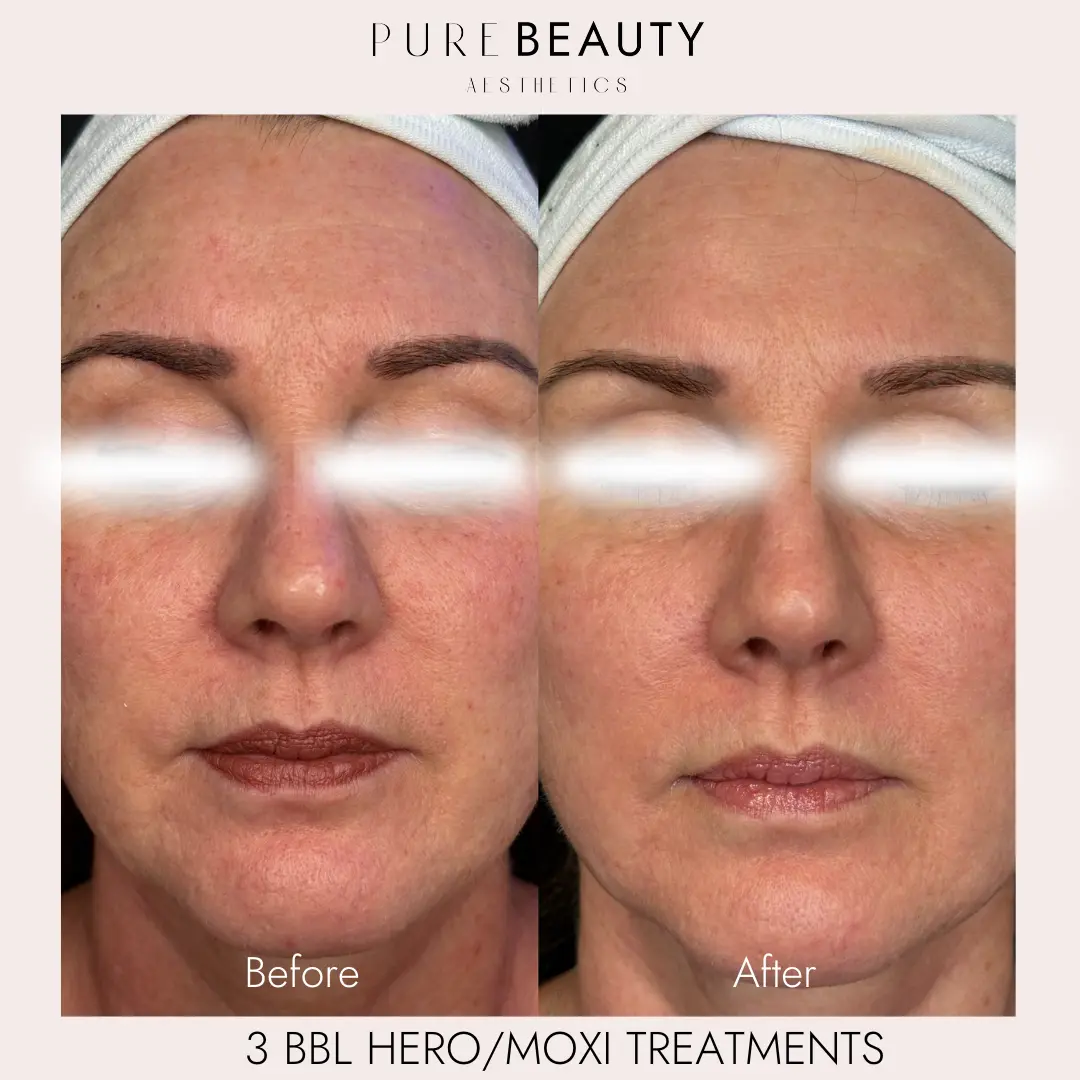 Pure Beauty Aesthetics Before & After 17