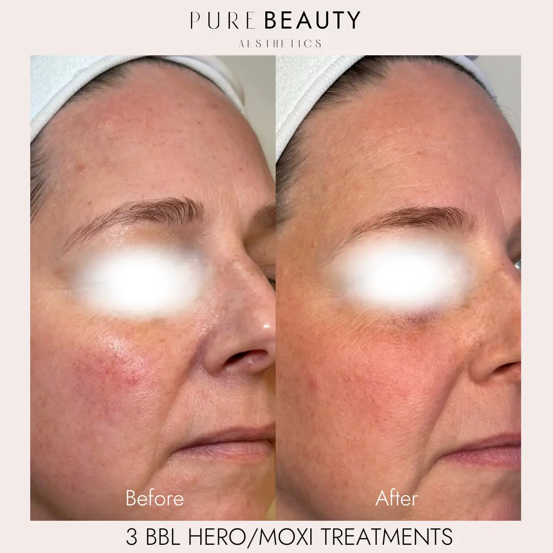 Pure Beauty Aesthetics Before & After 18