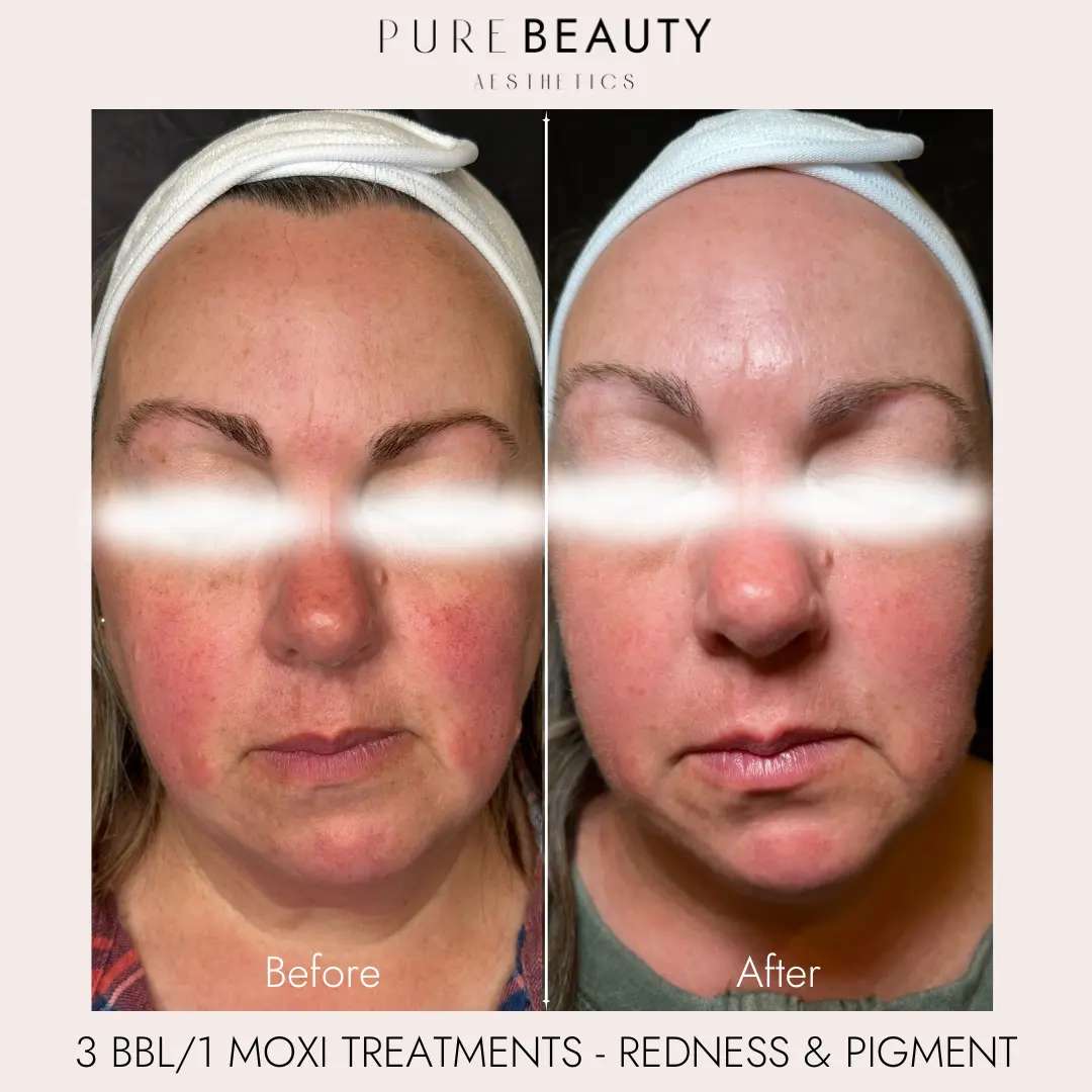 Pure Beauty Aesthetics Before & After 2