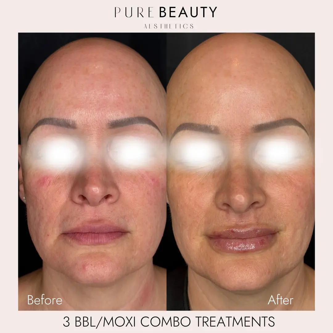 Pure Beauty Aesthetics Before & After 26
