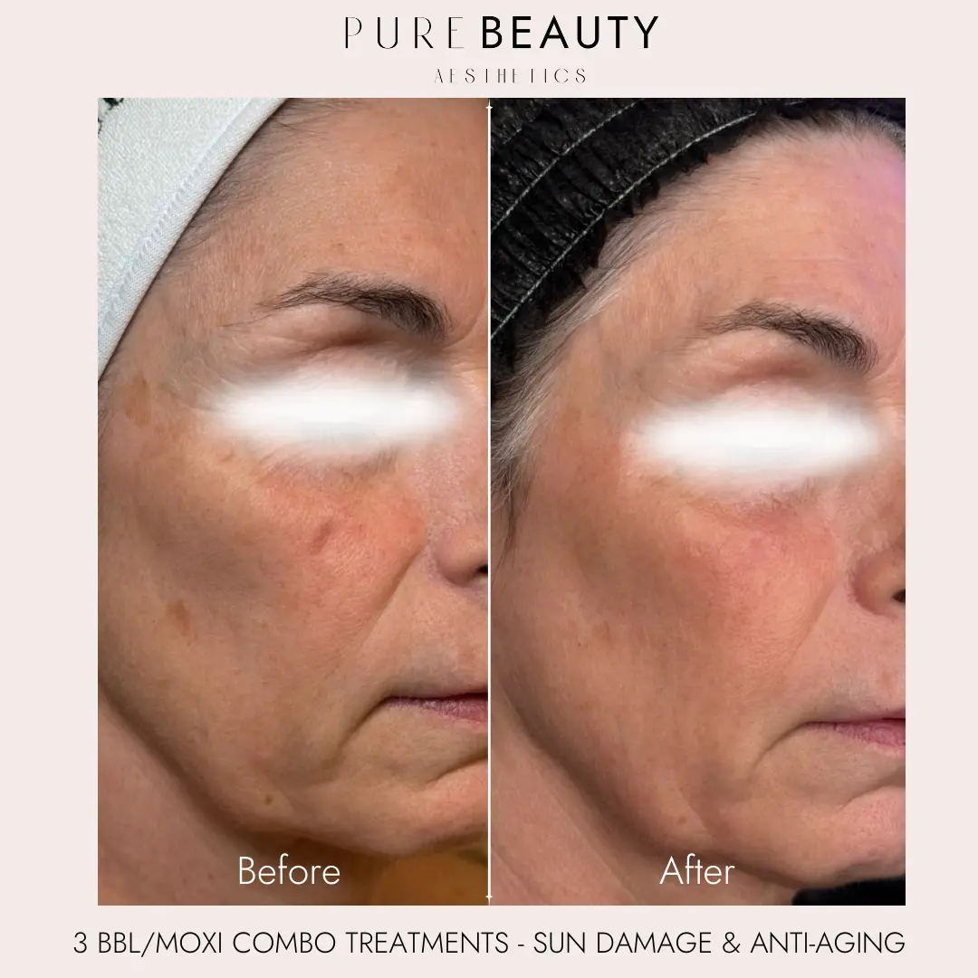 Pure Beauty Aesthetics Before & After 3