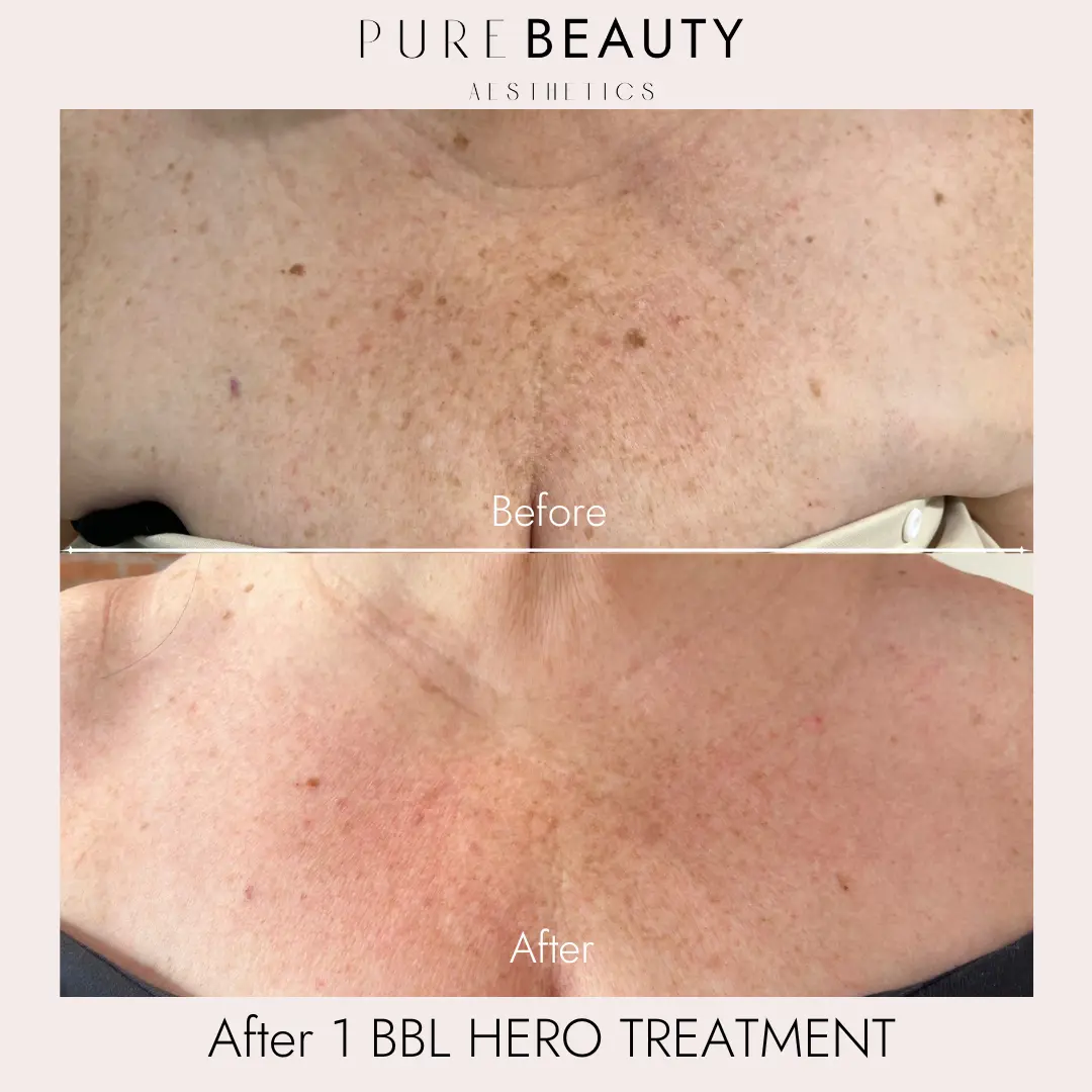 Pure Beauty Aesthetics Before & After 4