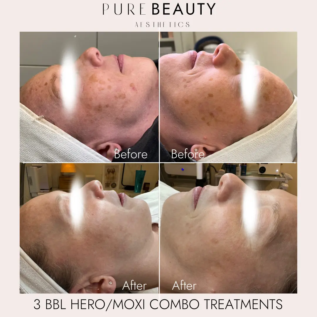 Pure Beauty Aesthetics Before & After 5