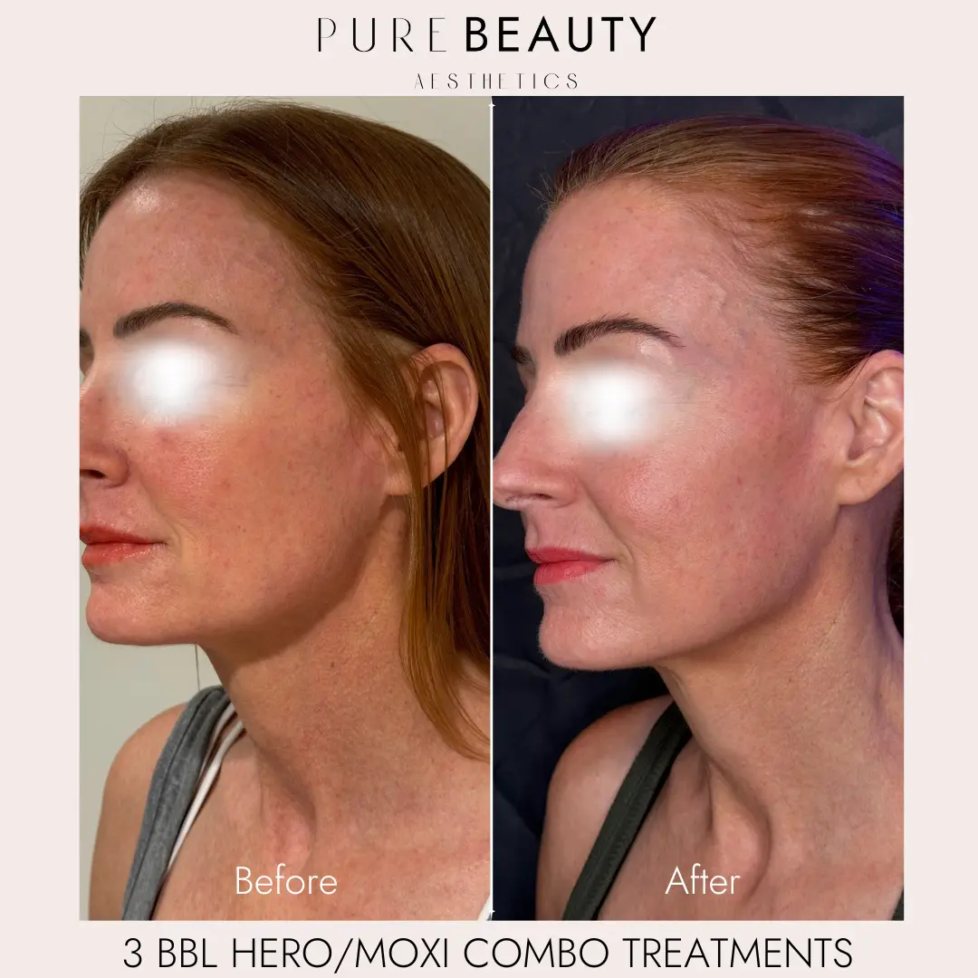 Pure Beauty Aesthetics Before & After 6