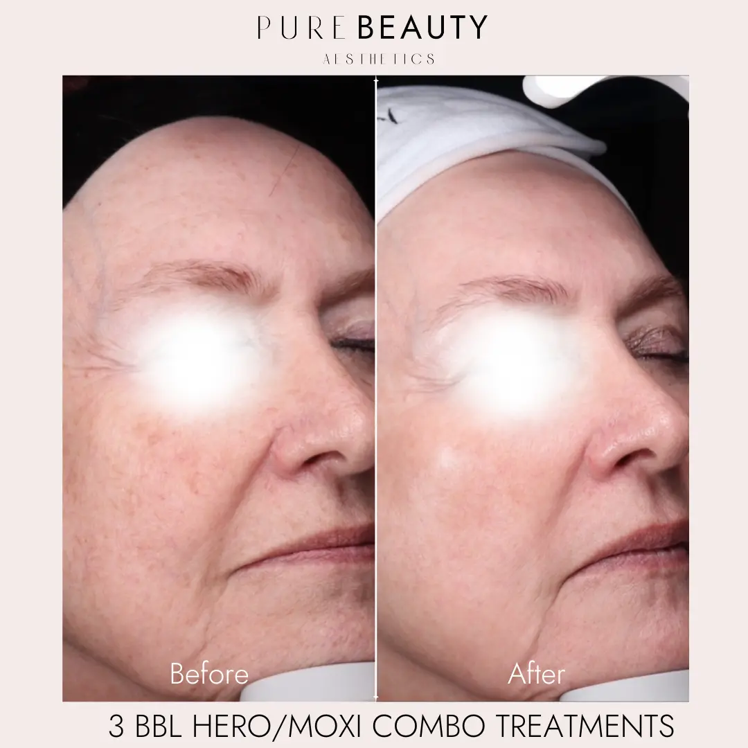 Pure Beauty Aesthetics Before & After 7