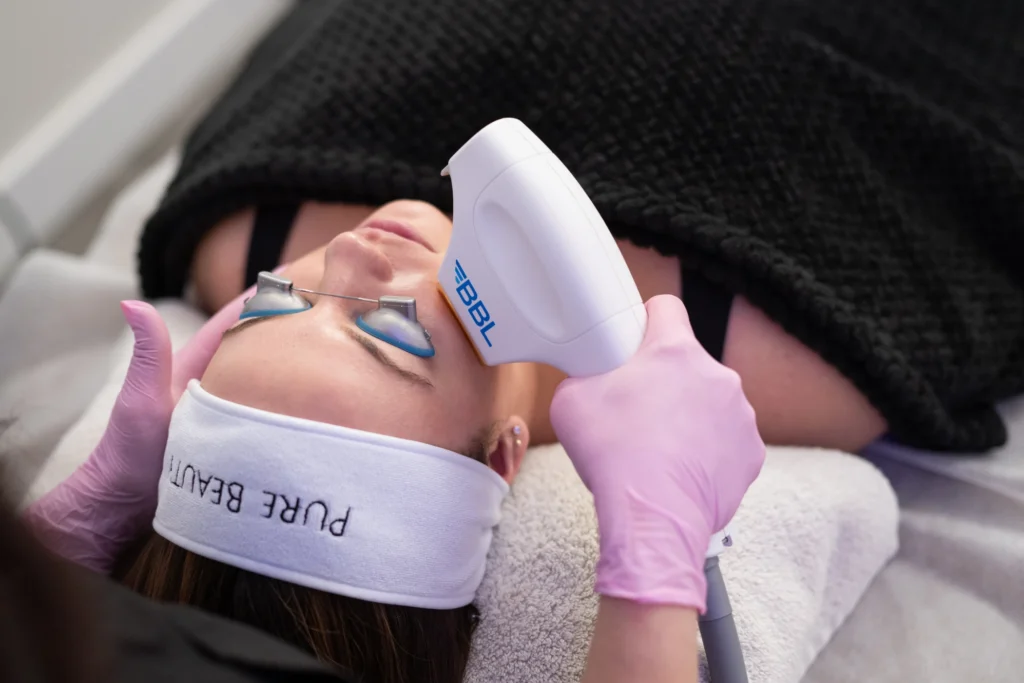 Woman Receiving Forever Young BBL Hero at Pure Beauty Aesthetics in Albany, OR