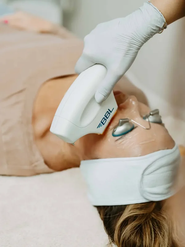 BBL Photofacial treatment to a lady at pure beauty aesthetics in Albany