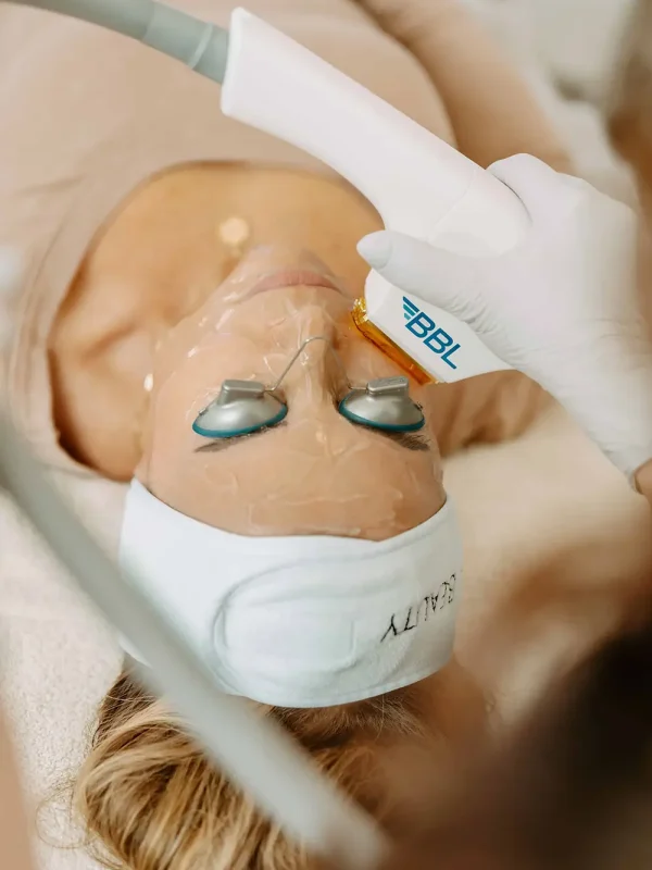 Lady getting Sciton Forever BBL Photofacial in Albany, OR
